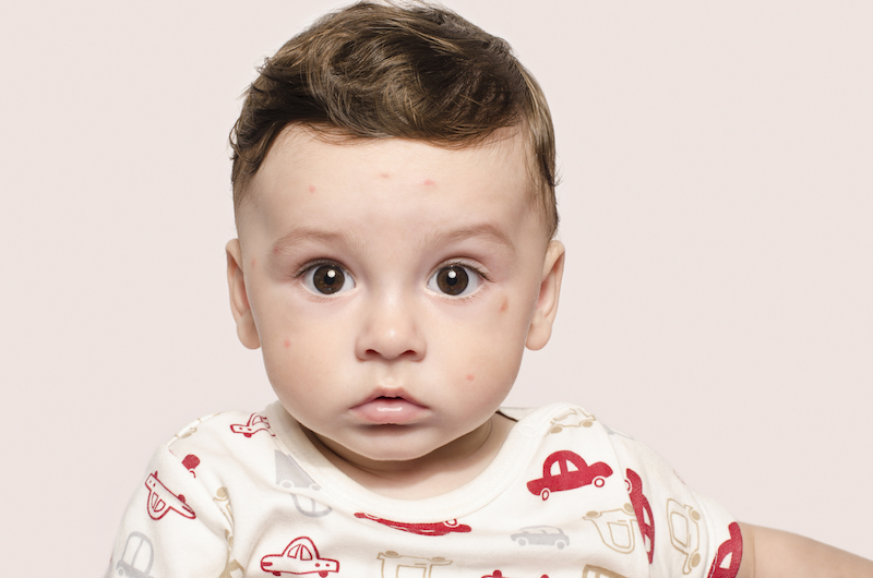 Niño con erupción