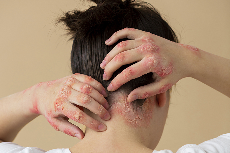Psoriasis